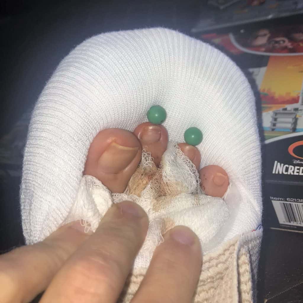 pins in toes